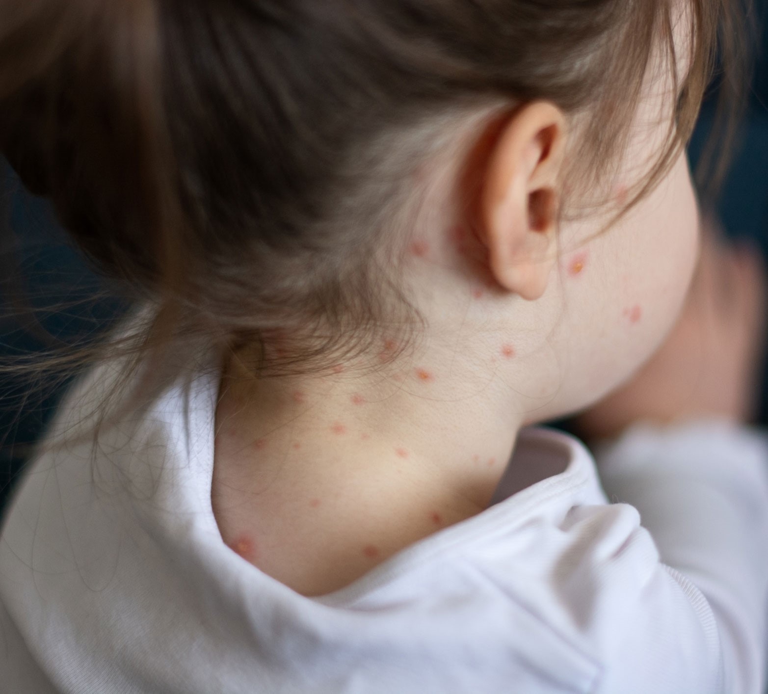 Measles shown on back of young child's neck