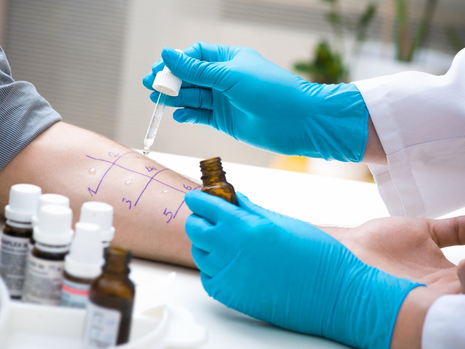 Close-up of a healthcare professional wearing blue gloves performing an allergy skin test, placing drops of solution on a patient's forearm marked with numbered test sites, with small medical vials and testing materials visible in the foreground.